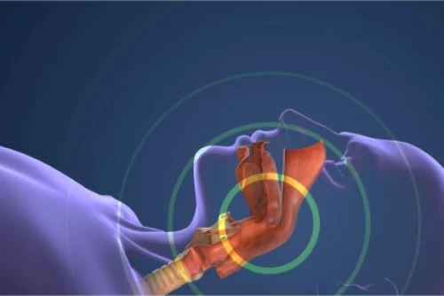 Sleep Apnea and Weight Loss – Understanding the Connection